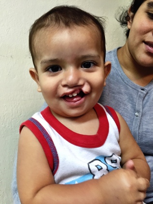 This little guy was 1.5 years old with a cleft lip.