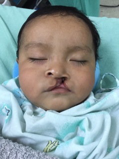 Left unilateral cleft lip, Guatemala